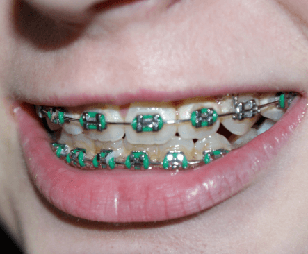 Orthodontics Dentistry
